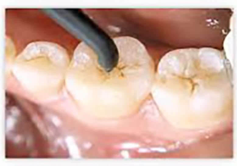 cavity cavity